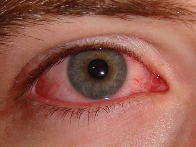 Conjunctivitis (Pink Eye) Prevention and Cure 