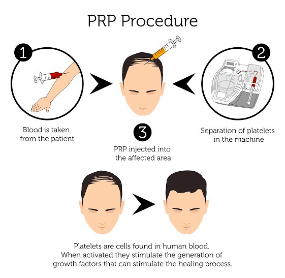 PRP Procedure to promote Hair growth 