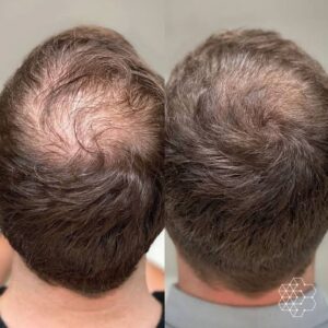 What causes Hairfall from Crown area and how to prevent baldness 