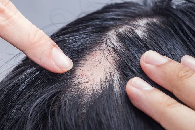 What is Alopecia and How to treat alopecia