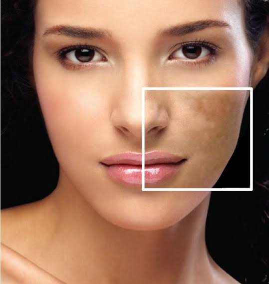 What is Hyperpigmentation and why it happens