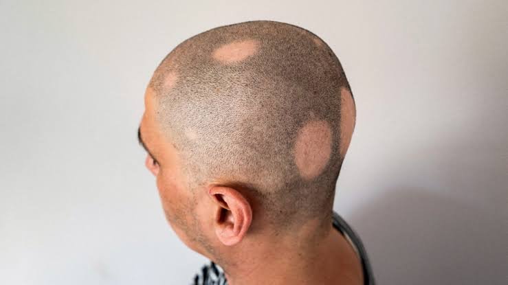 Symptoms of Alopecia Areata