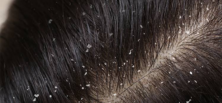 What causes Dandruff? How it is formed in scalp