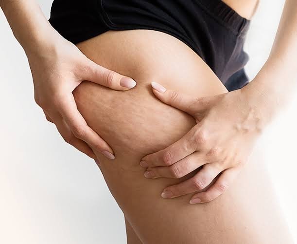 What is Cellulite skin and What is the treatment of Cellulite