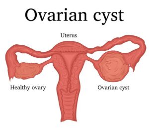 Treatment of Ovarian cyst