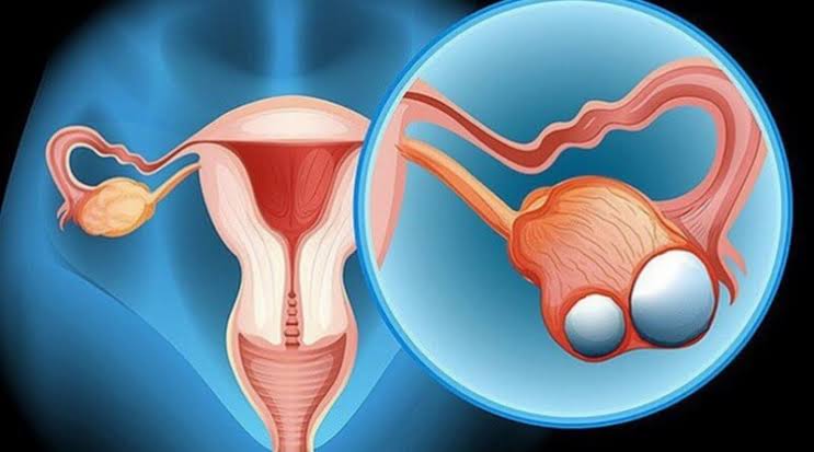 What are ovarian cyst and their symptoms